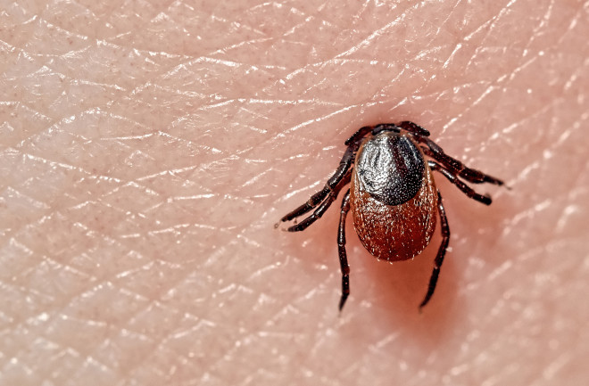 Sucking tick Macro photo on human skin. Bloated parasite bitten into pink irritated epidermis.