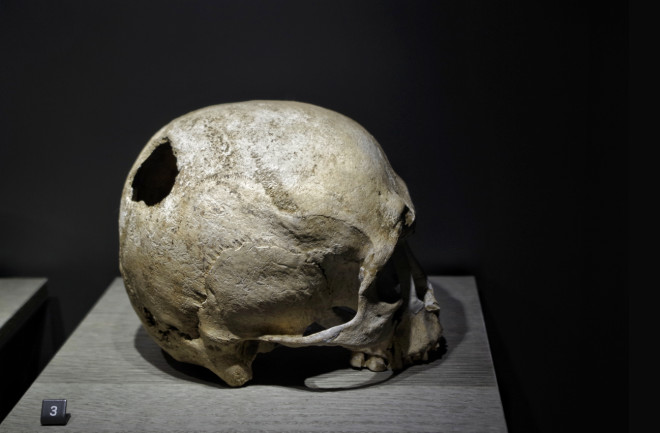 Skull showing traces of a trepanation surgical operation